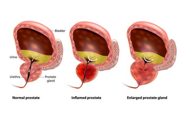 A prostatite é a inflamación da próstata