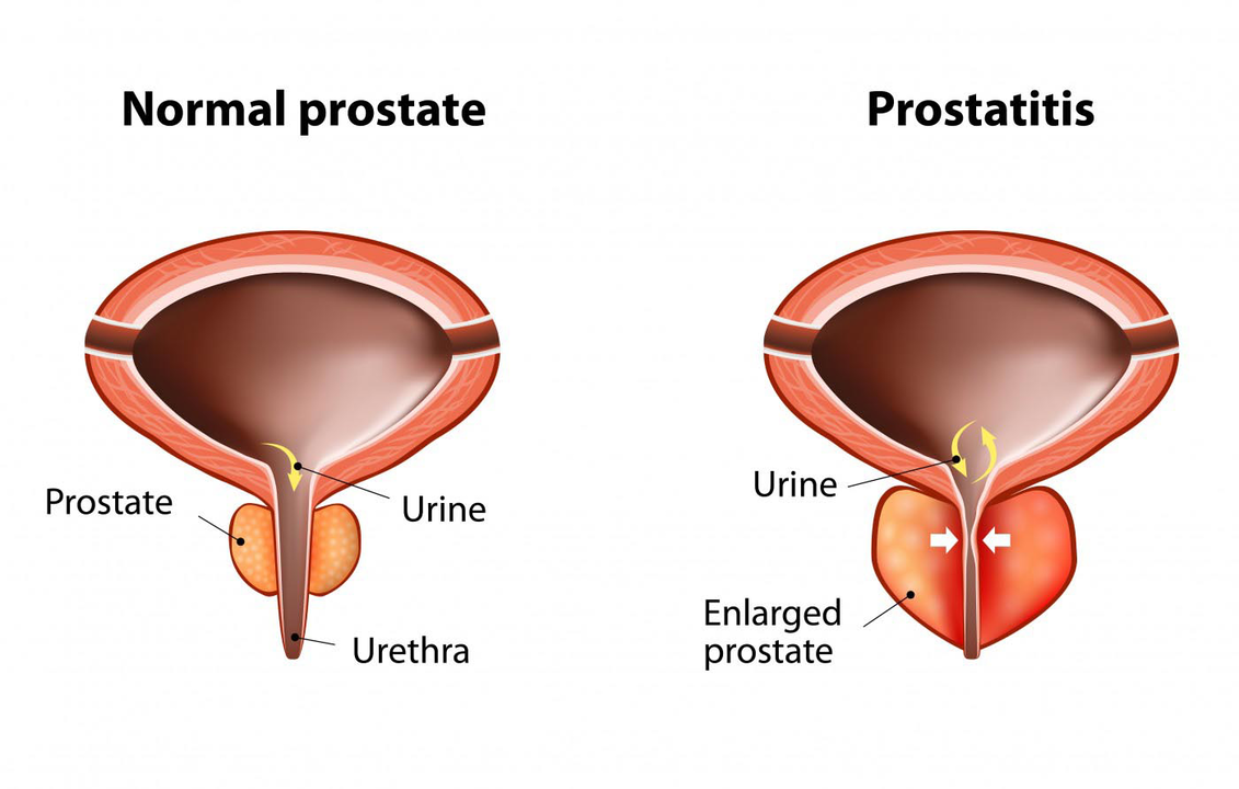 Próstata normal dun home san e inflamación da próstata con prostatite
